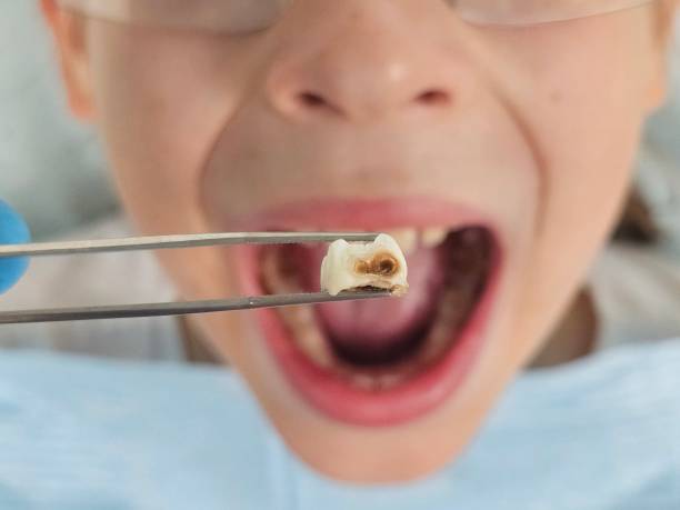 Best Root Canal Emergency Dentist  in Huntington, TX